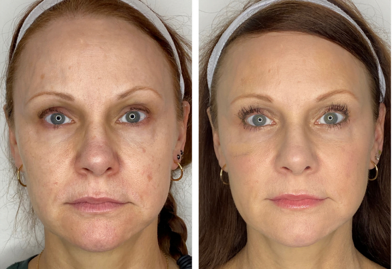 showing effects of mid face filler