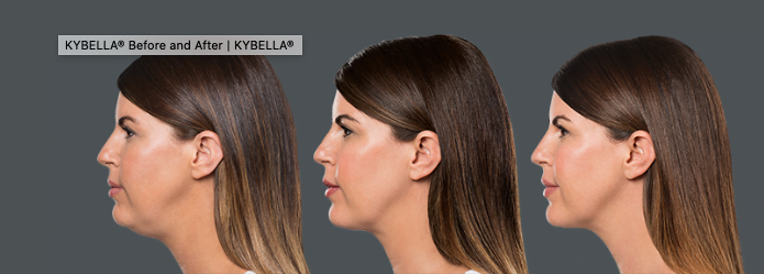 Kybella before/afters