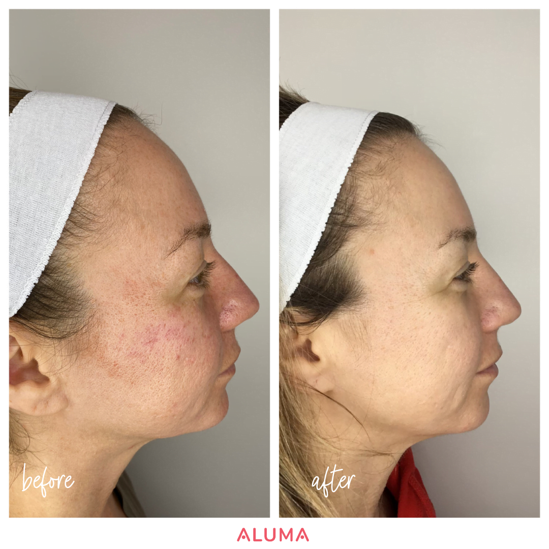 In this photo you can see the reduced acne scarring associated with microneedling treatments for this person who was treated at Aluma Aesthetic Medicine in Portland, OR.