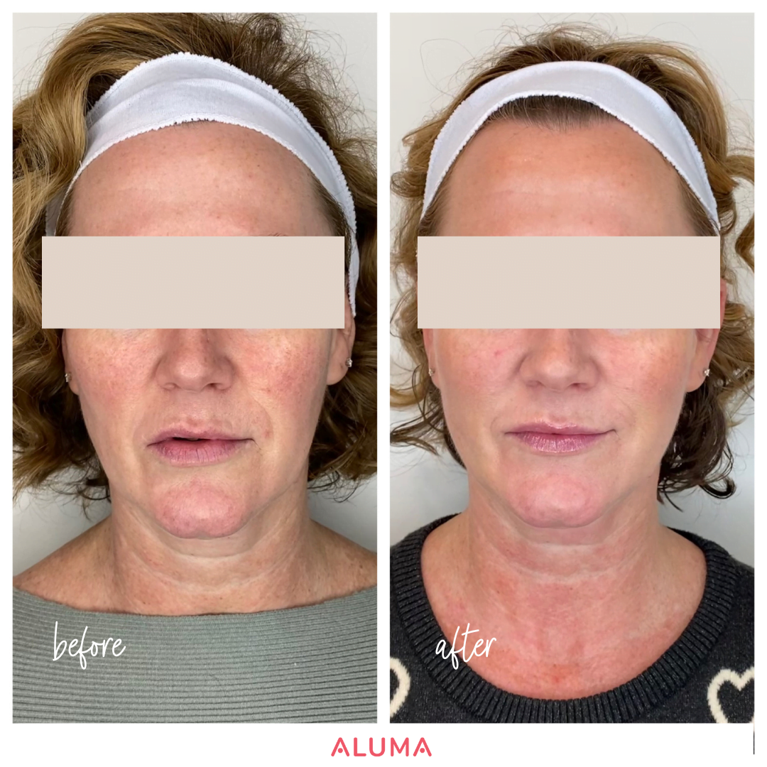 Image depicting a before and after picture of a Threads treatment with Instalift threads showing the lifting and skin tightening effects of threads on the lower facial areas