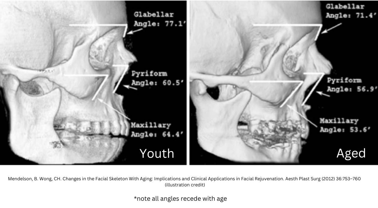 graphic of skull showing bones receding with age
