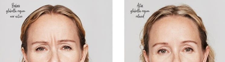 Botox injection photos before and after a woman has a more wrinkle free forehead