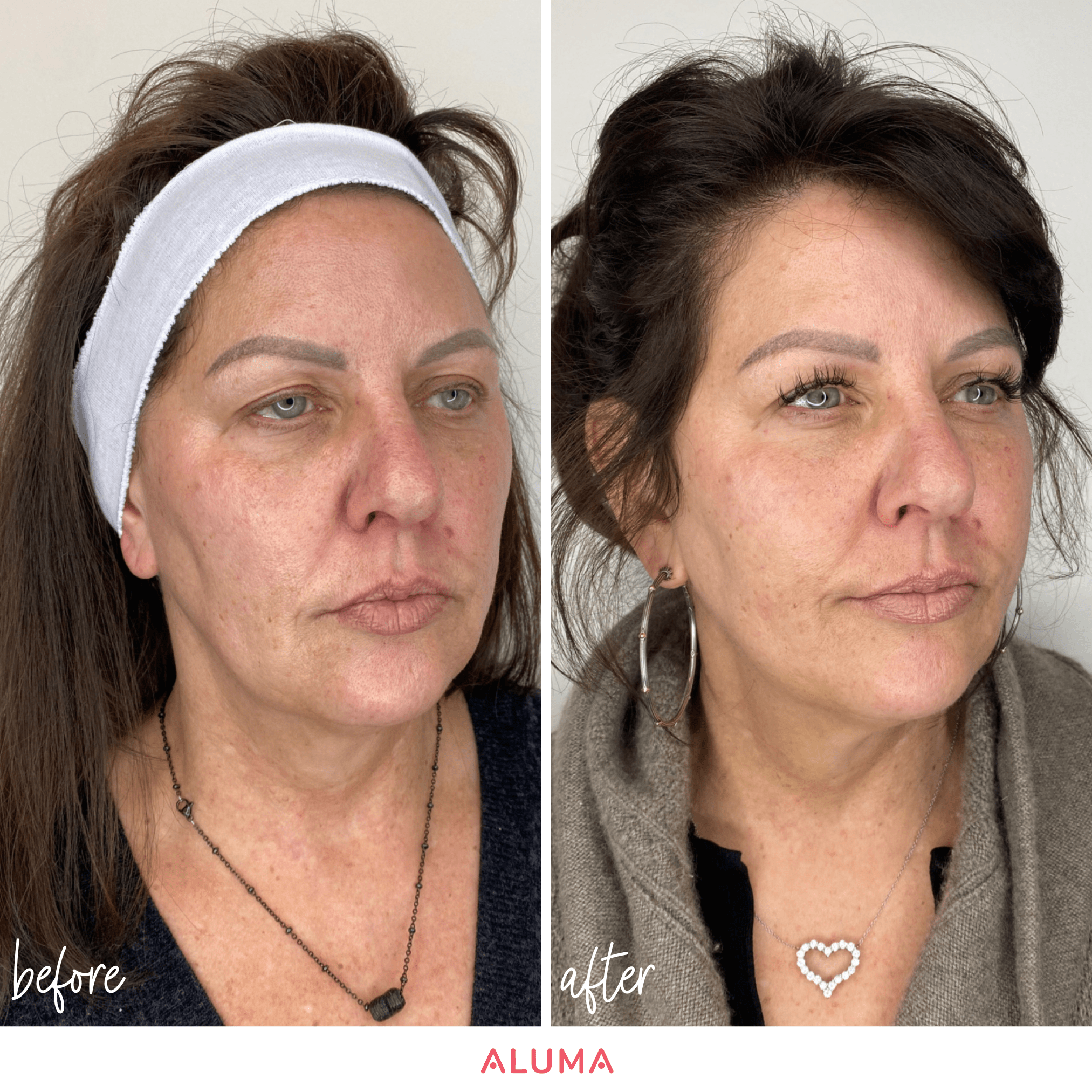 This picture shows the lifting capacity of a threads treatment by showcasing a before and after photo of a thread treatment that Dr. Brigham performed al Aluma Aesthetic Medicine in Portland, Oregon.