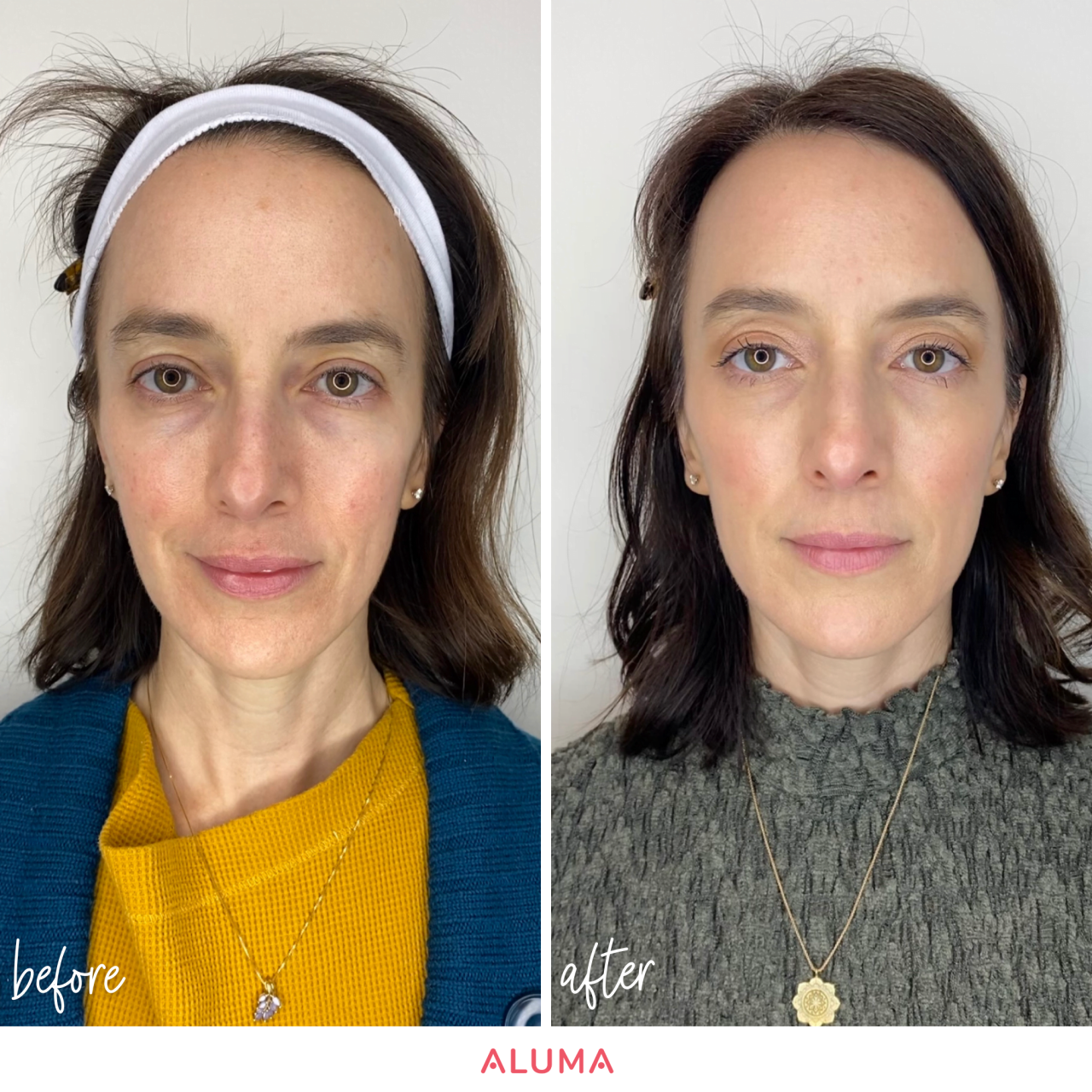 Sculptra Aesthetic, Biostimulation to Rejuvenate the Face