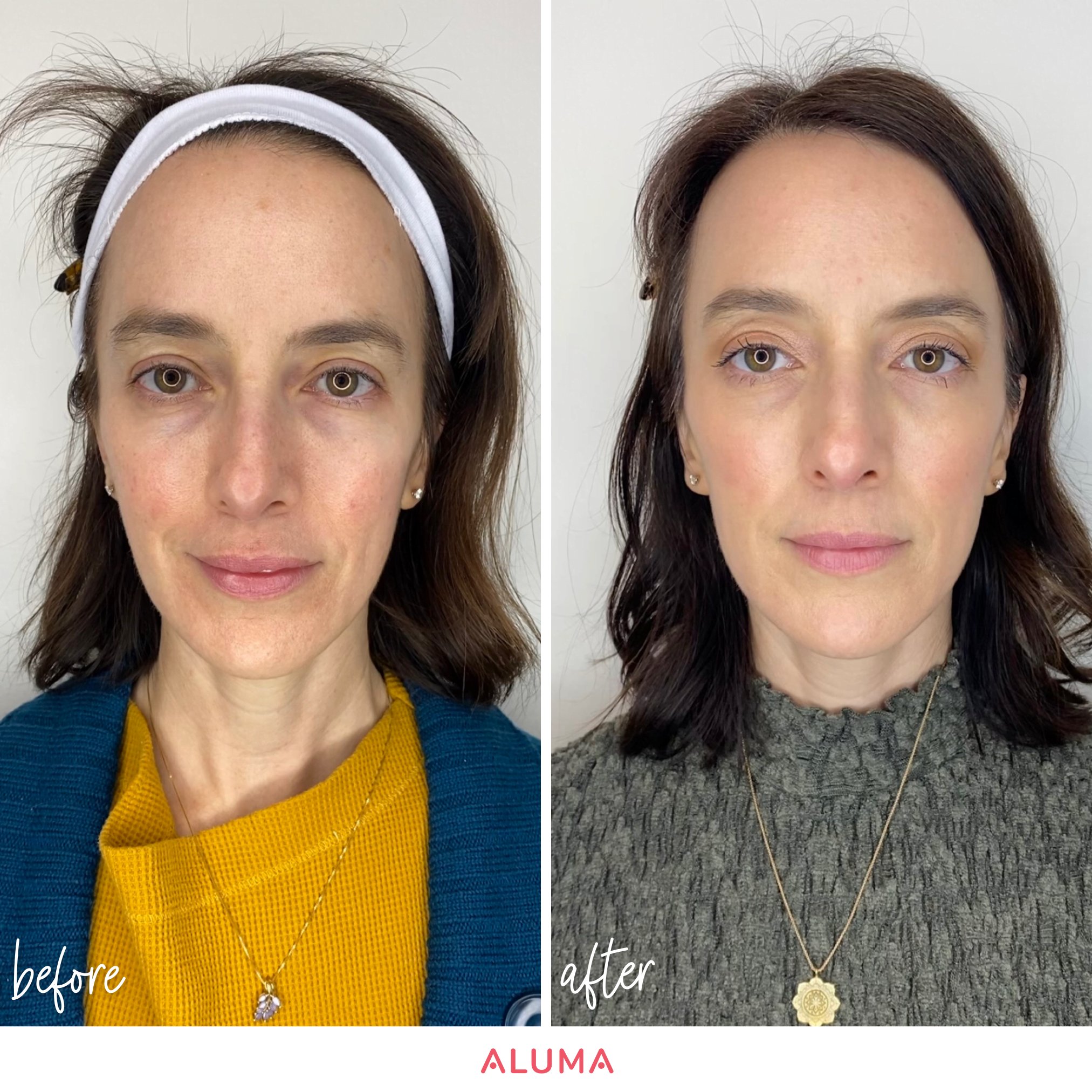 n this photo, you can see the bio-stimulating positive effects, such as volumized skin, tighter jawline, and an overall refreshed appearance of a Sculptra treatment from a woman who was treated at Aluma Aesthetic Medicine in Portland, Oregon. This picture is a before and after photo shot in frontal view.