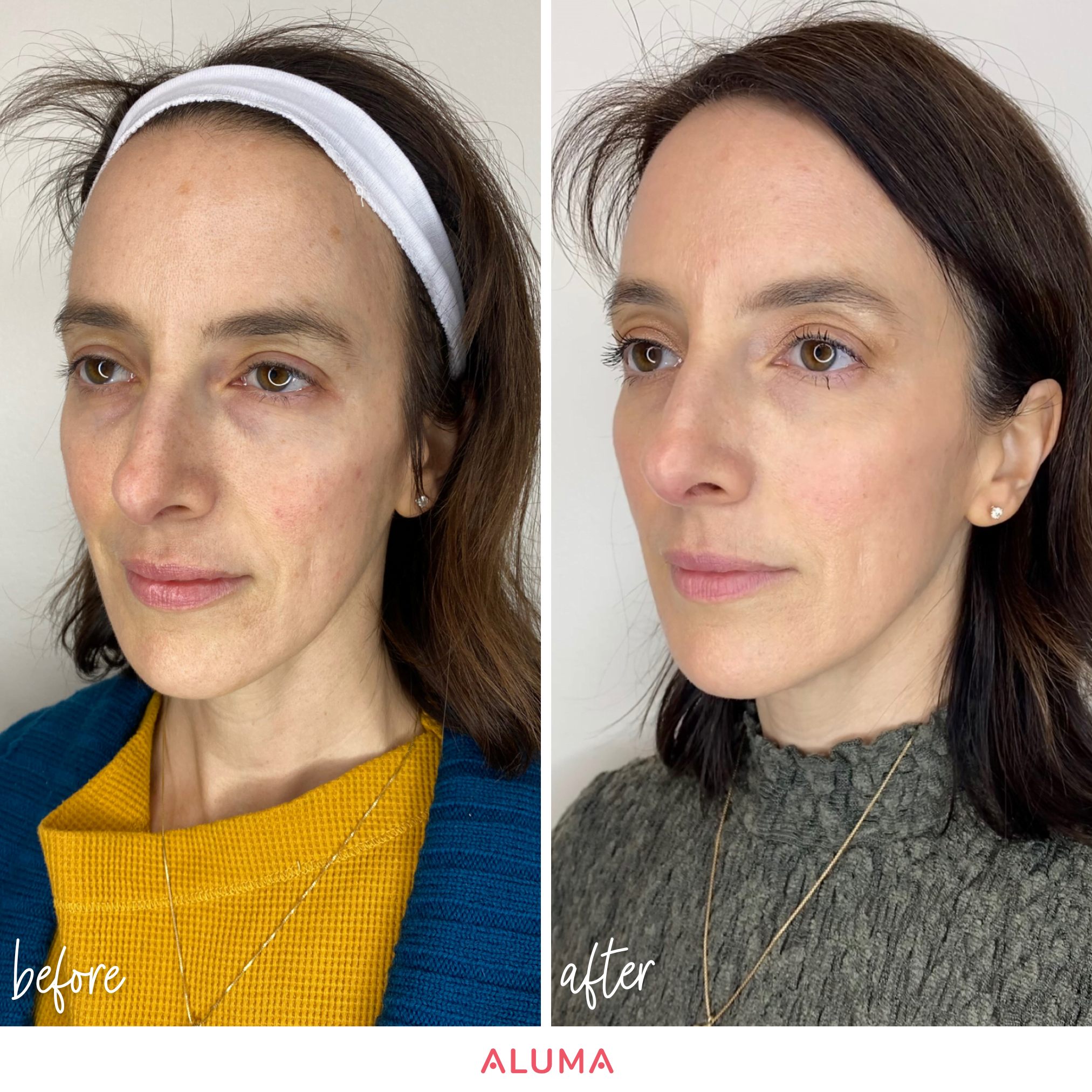 n this photo, you can see the bio-stimulating positive effects, such as volumized skin, tighter jawline, and an overall refreshed appearance of a Sculptra treatment from a woman who was treated at Aluma Aesthetic Medicine in Portland, Oregon. This picture is a before and after photo shot in 3/4's view.