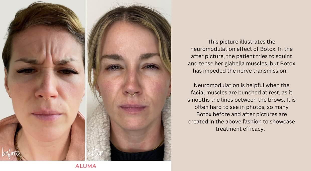 This picture illustrates the neuromodulation effect of Botox. In the after picture, the patient tries to squint and tense her glabella muscles, but Botox has impeded the nerve transmission. Neuromodulation is helpful