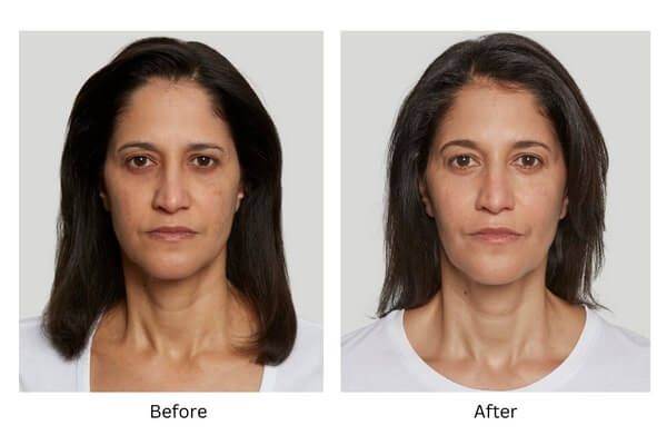 Before and After Sculptra photos for a woman treated by Aluma Aesthetic Medicine 