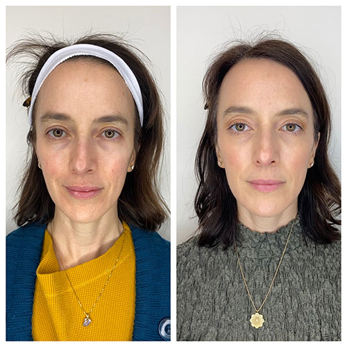 A picture of Sculptra results 