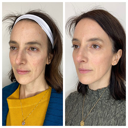 This is a before and after picture that shows a woman with dark hair and light skin and brown eyes who benefited from sculptra in Portland, OR at Aluma.