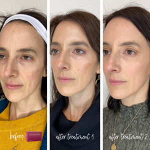 This pictures shows the before and afters of a three part sculptra treatment series documenting improved skin health in a 44 year old woman. 