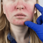 This photo shows a woman with severe rosacea 
