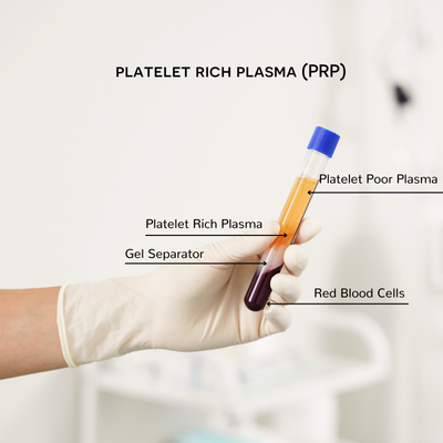 PRF sample in vial for PRF microneedling 