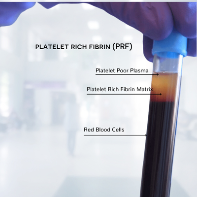 PRF vial for PRF microneedling showing different layers of blood separation