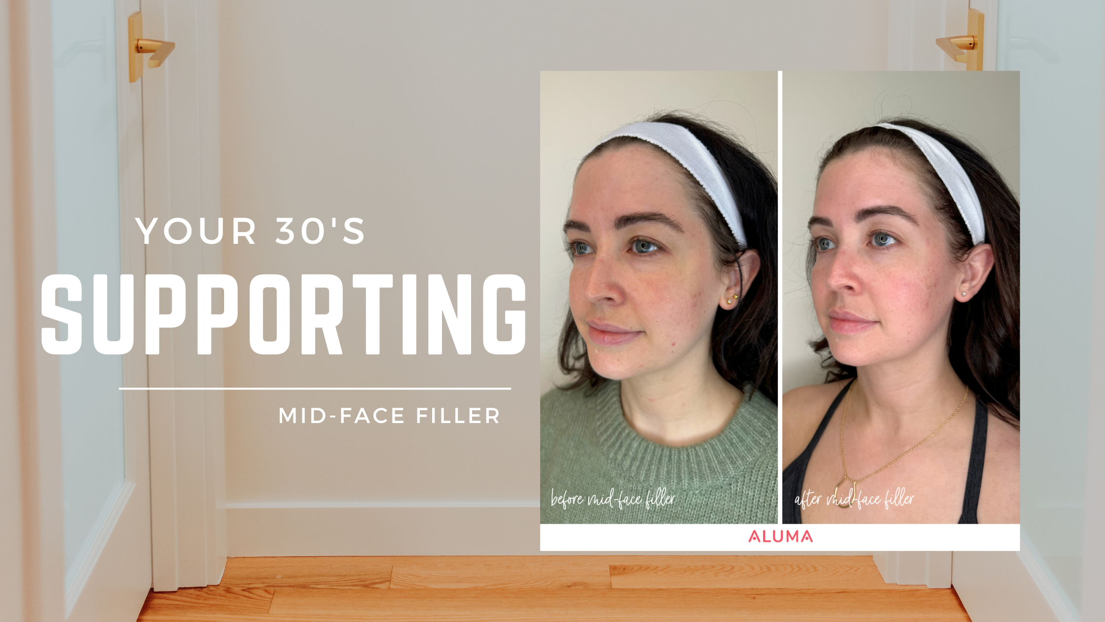 Picture of a Before After dermal filler for mid-face at Aluma Aesthetic Medicine in Portand, OR