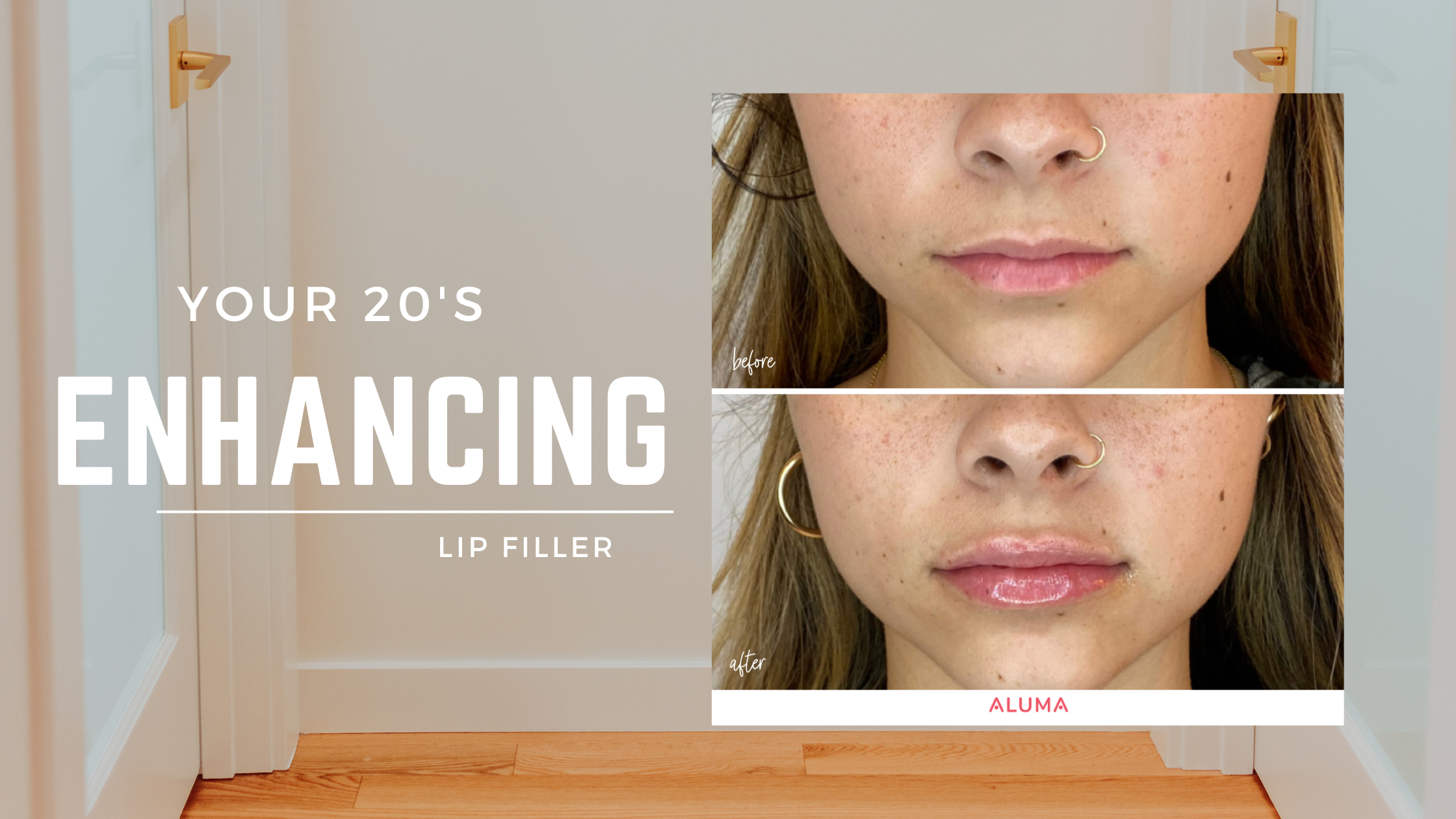 Picture of a Before After lip filler at Aluma Aesthetic Medicine in Portland, OR