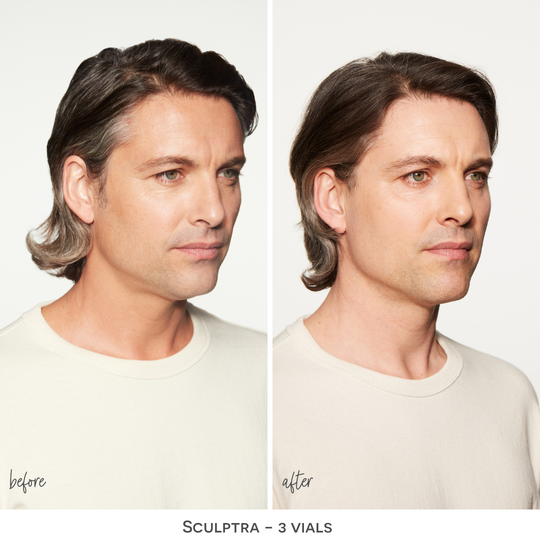 Before After Sculptra picture; side to side changes from Sculptra injections