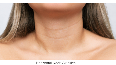 Photo of horizontal neck lines 