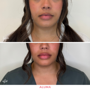 Before and after lip filler photo of uneven lips top top lip to bottom lip proportions corrected by Dr. Nathaniel Brigham of Aluma Aesthetic Medicine