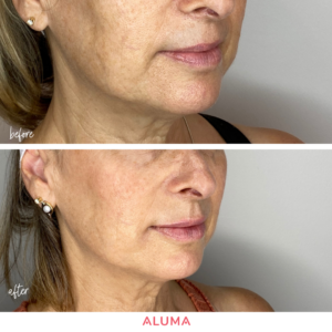 Before/After photos of lip filler for a woman in her 50's with an aging lip shape.