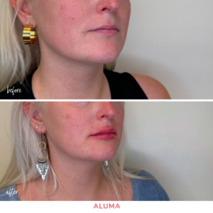 Before and after lip filler in Portland treatment at Aluma Aesthetic Medicine showcasing enhancement of thin lips.