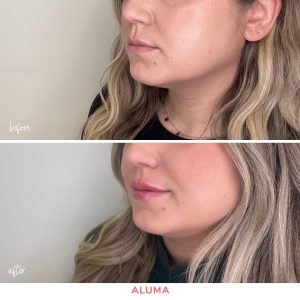 before and after photo of previously pout lips enhanced by Alume Aesthetic Medicine in Portland, OR.