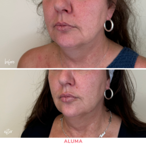 before and after photo of previously pout lips enhanced by Dr. Nathaniel Brigham in Portland, OR. 