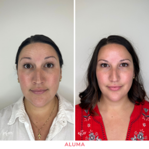 Before and after Botox image showcasing the smoothing of lines on the forehead on a woman aged 35. 