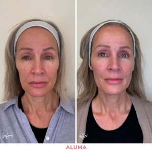 before and after photo of woman in her 50's post a Instalift thread lift