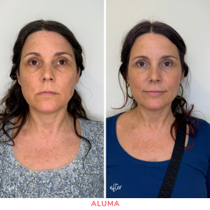 before after results picture from instalift thread treatment by Dr. Brigham