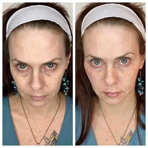 before and after photo of woman who had dermal filler for her undereyes