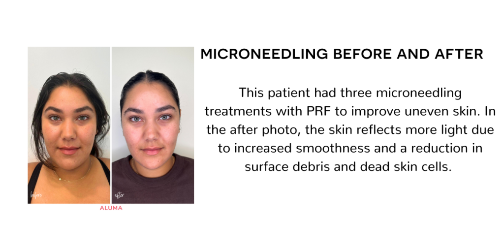 microneedling before and after photo showing an increase in brighness and decrease in dull skin