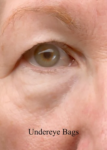 Close-up of under-eye bags showing puffiness beneath the eyes.