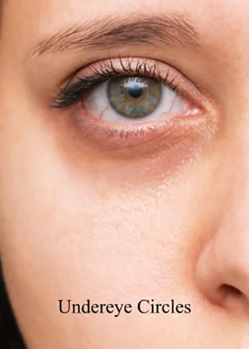 Close-up of under-eye circles to illustrate common causes of tired-looking eyes.