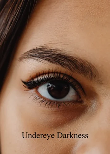 Close-up of under-eye darkness illustrating pigmentation and shadowing concerns.