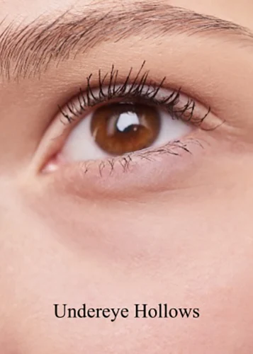Close-up of under-eye hollows and tear trough volume loss.