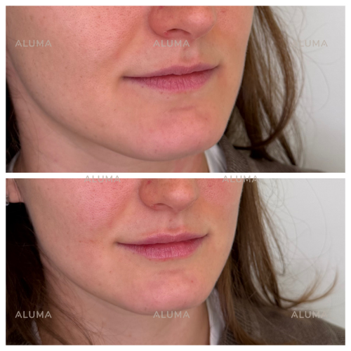 Before/After lip filler photo