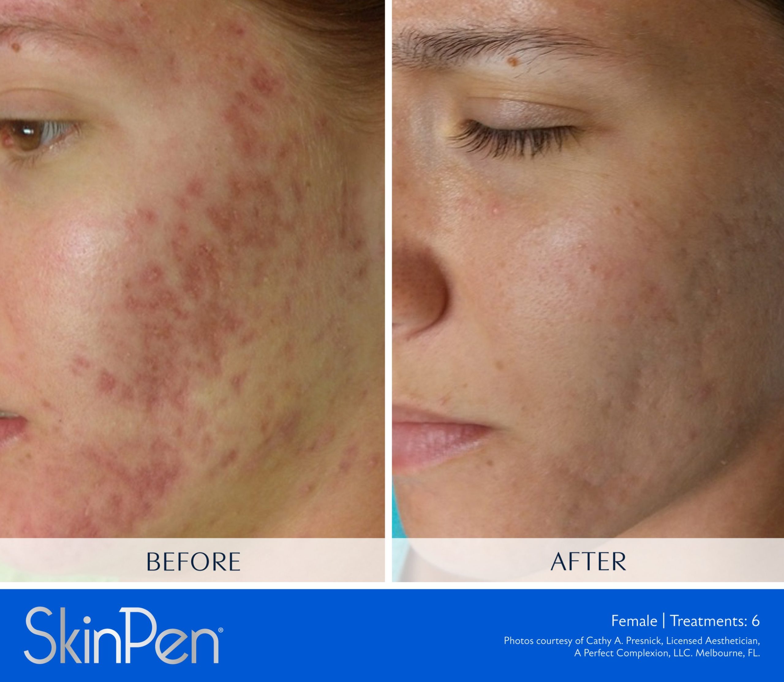 Before and after SkinPen microneedling on a woman's cheek, showing softened acne scarring and redness after 6 treatments