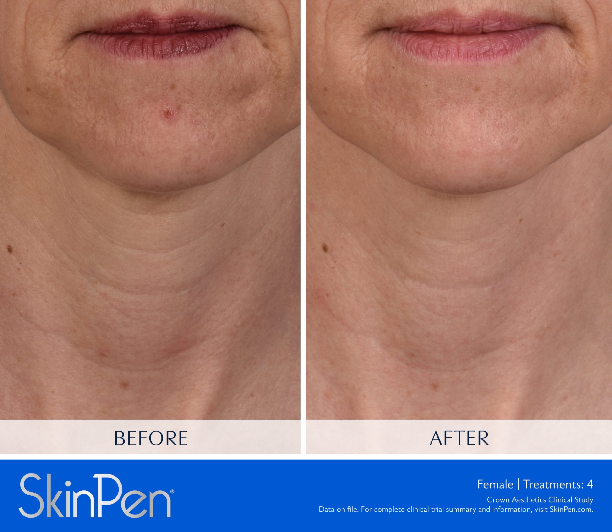 Before and after SkinPen microneedling on a woman's neck, showing softer horizontal neck wrinkles after 4 treatments