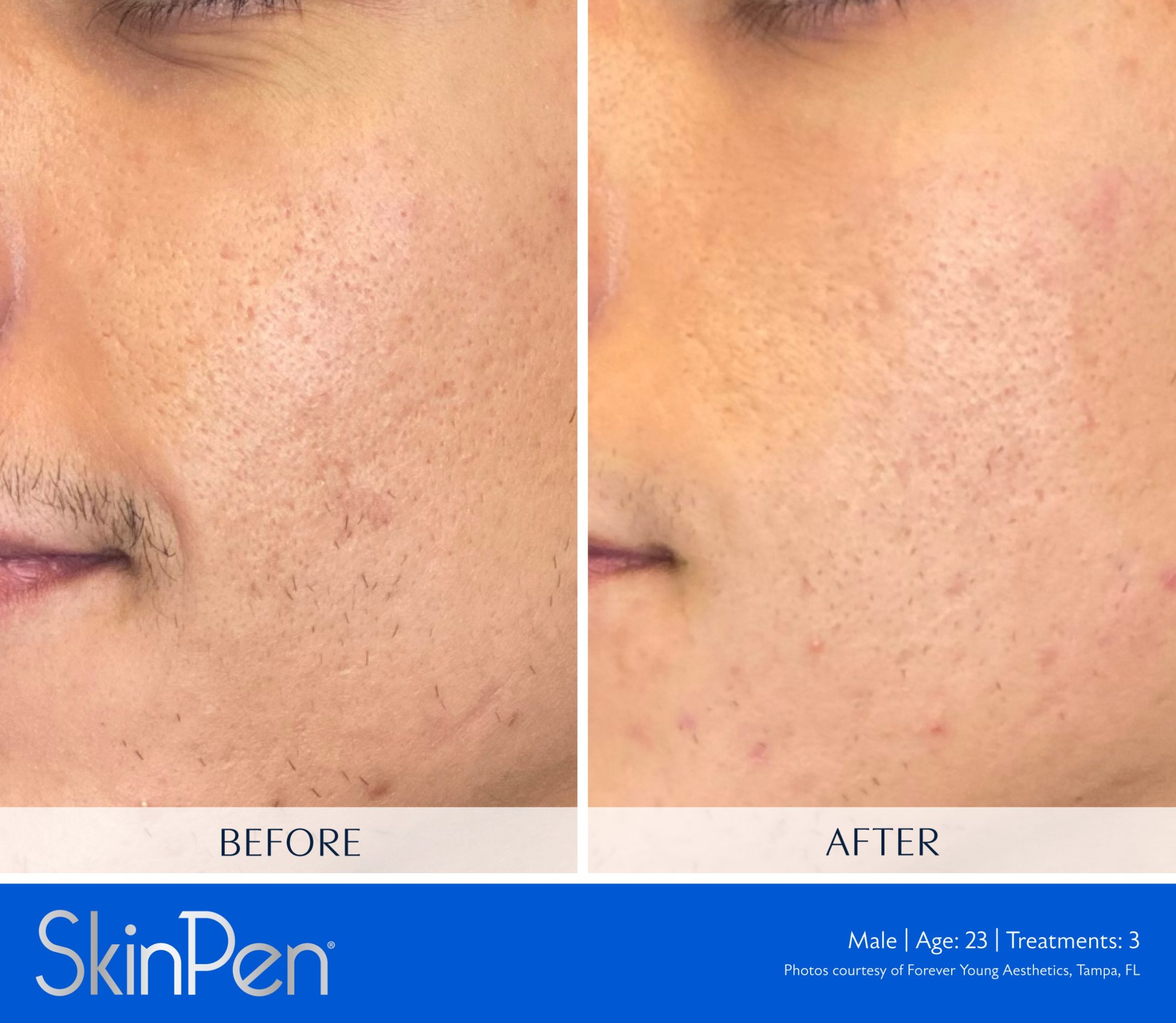 Before and after SkinPen microneedling on a 23-year-old man's cheek, showing smoother texture and less visible pores after 3 treatments