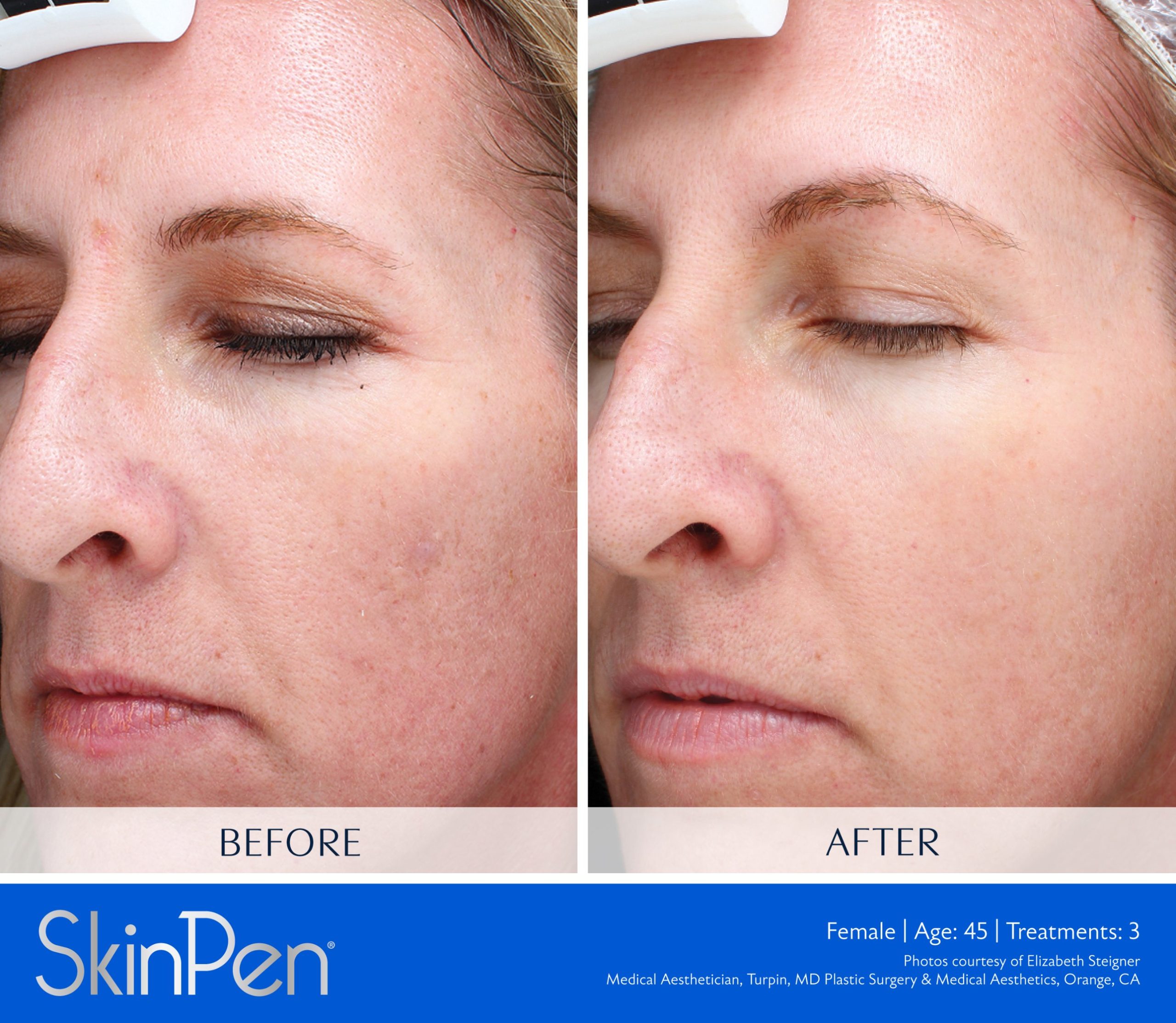 Before and after SkinPen microneedling on a 45-year-old woman's face, showing a more even tone and softer fine lines after 3 treatments